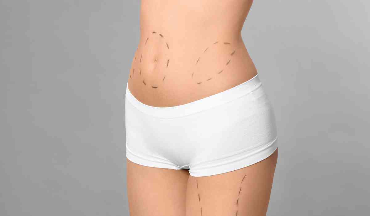 My-Tummy-Tuck-Surgery-Experience