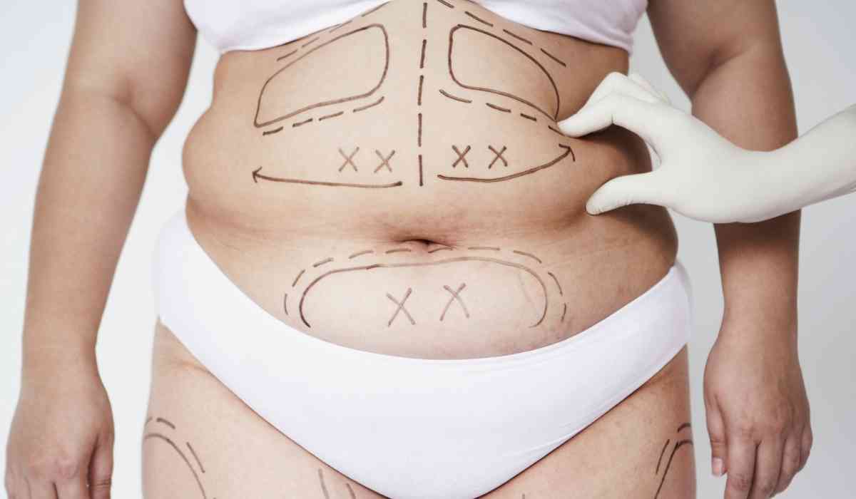 تكلفة-عملية-الفيزر-في-مصر