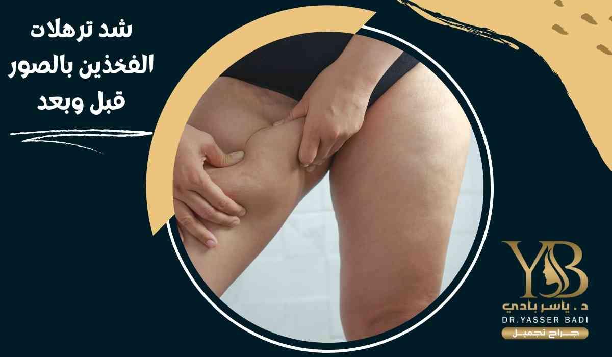 شد-ترهلات-الفخذين-بالصور-قبل-وبعد شد-ترهلات-الفخذين-بالصور-قبل-وبعد