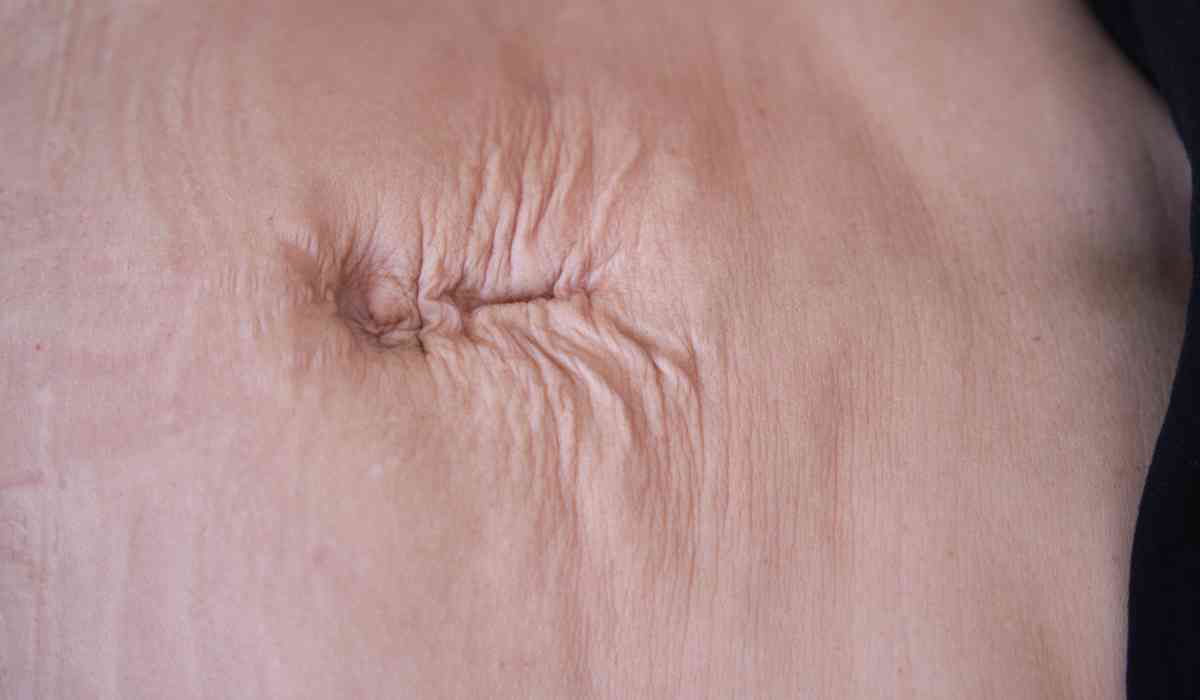 عملية-شد-البطن-بعد-الولادة