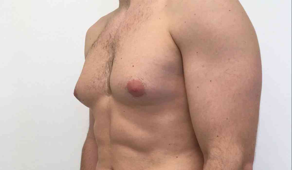 My-Experience-with-Gynecomastia-Surgery-in-Egypt