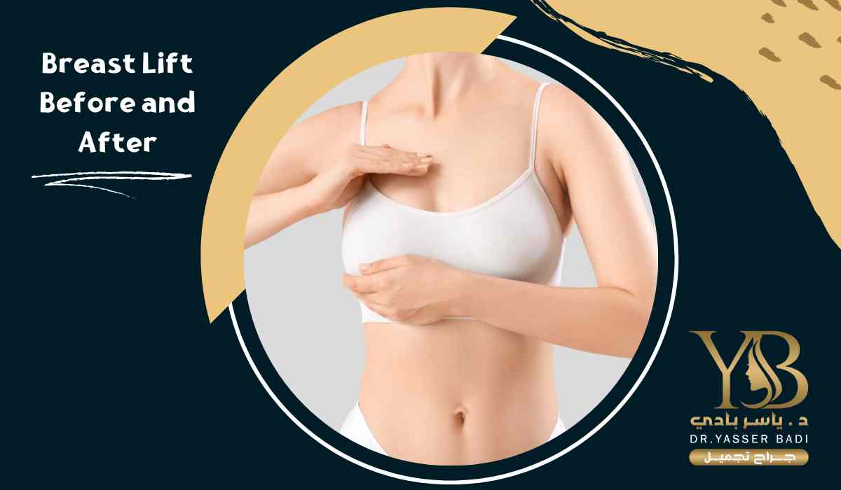 Breast lift before and after