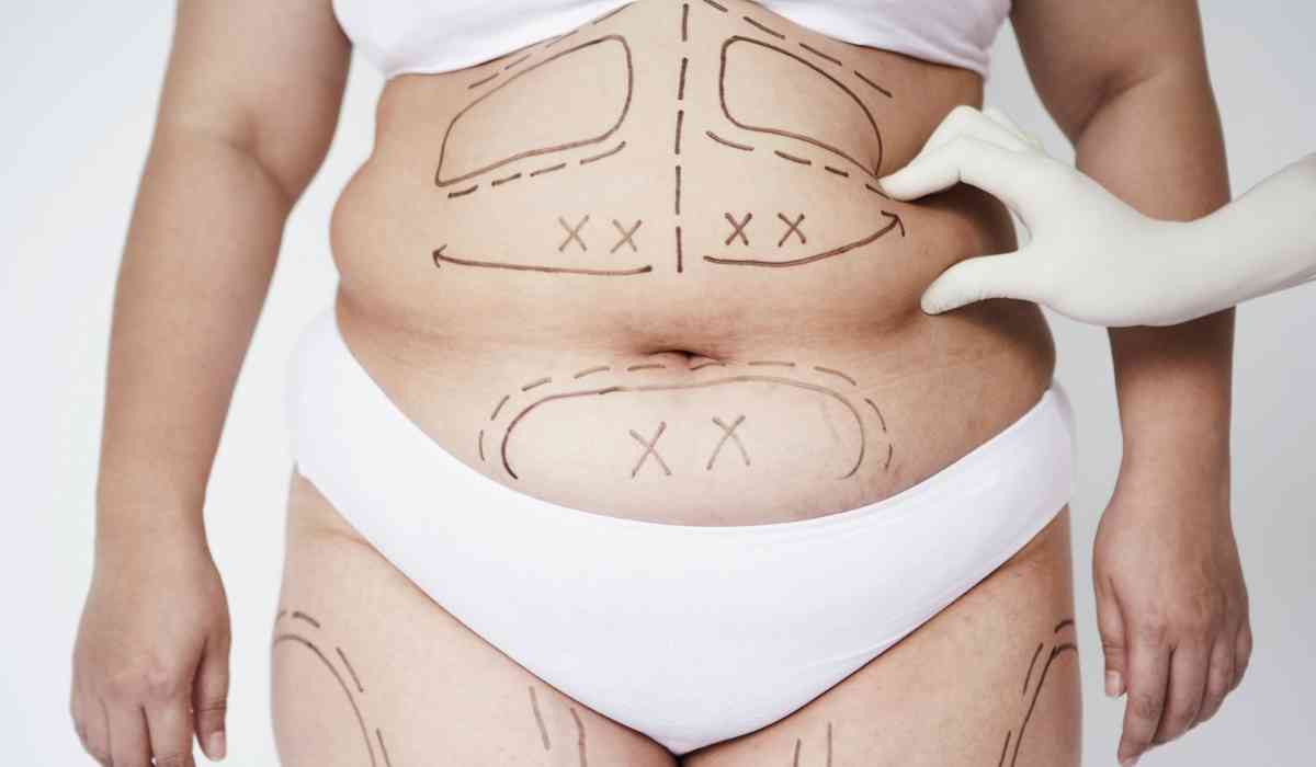 ما-هى-تكلفة-شفط-الدهون-فى-مصر؟