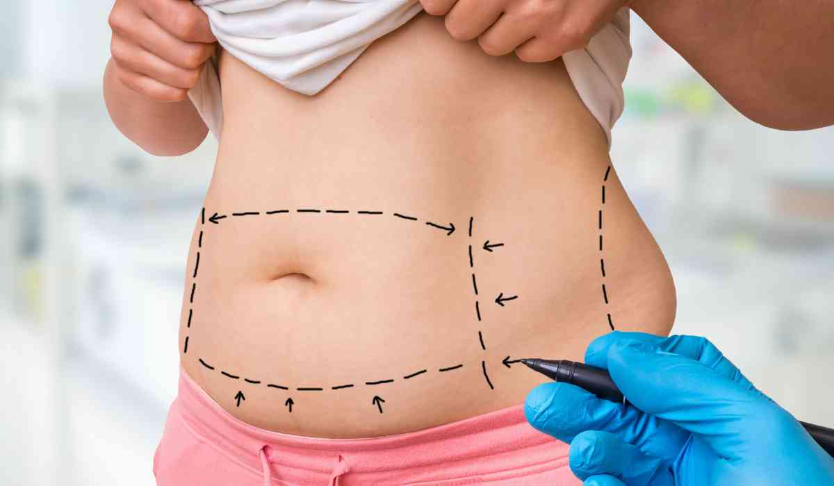 Liposuction-Surgery-Cost