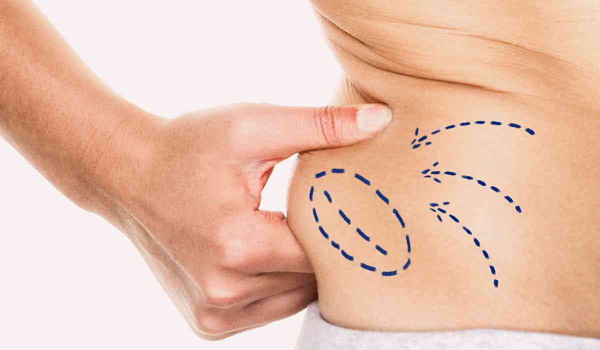 My-experience-with-Vaser-liposuction-in-2024