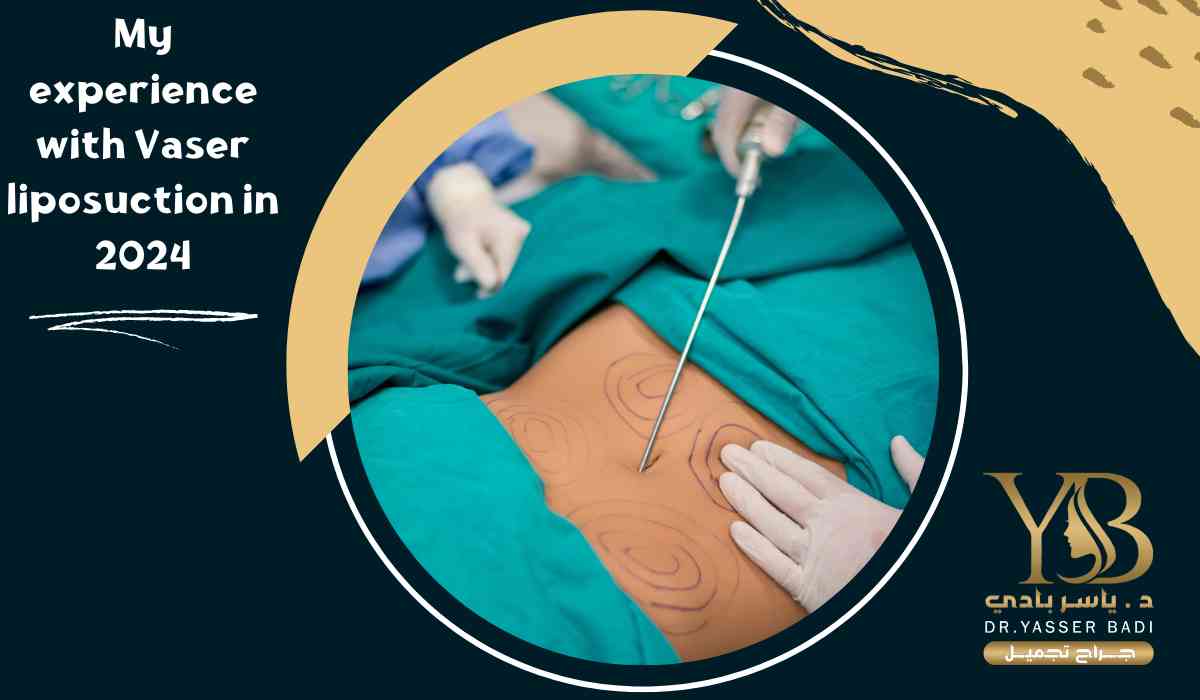 My experience with Vaser liposuction in 2024