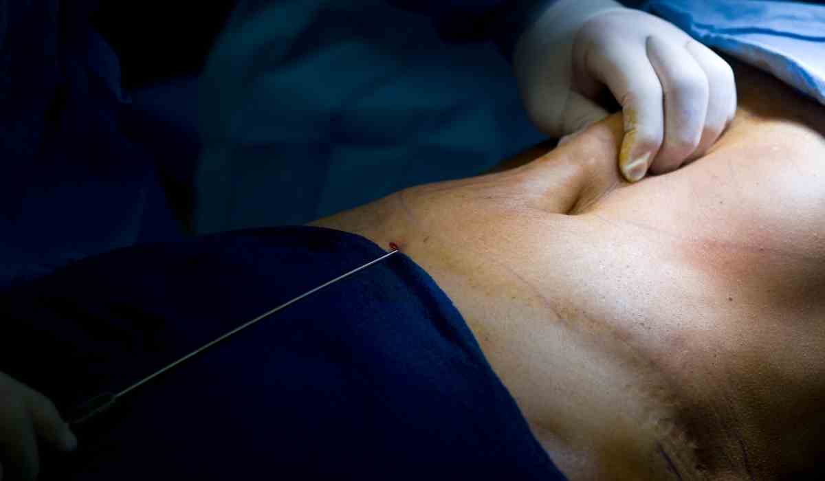 افضل-سعر-عملية-شفط-الدهون-د-ياسر-بادي