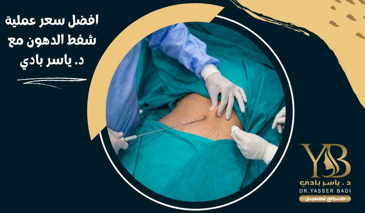افضل سعر عملية شفط الدهون مع د. ياسر بادي