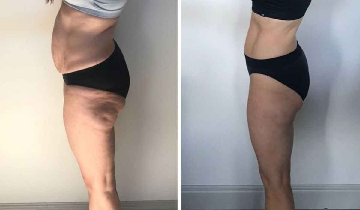 body-sculpting-before-and-after