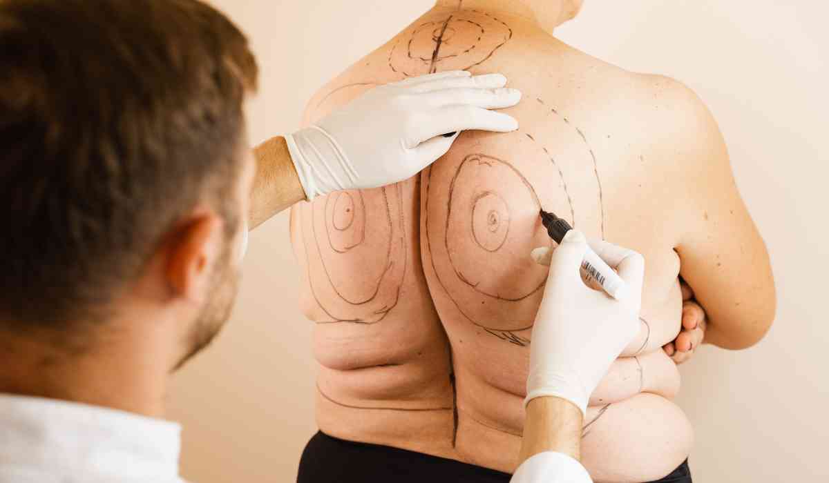 liposuction-doctor-in-Alexandria