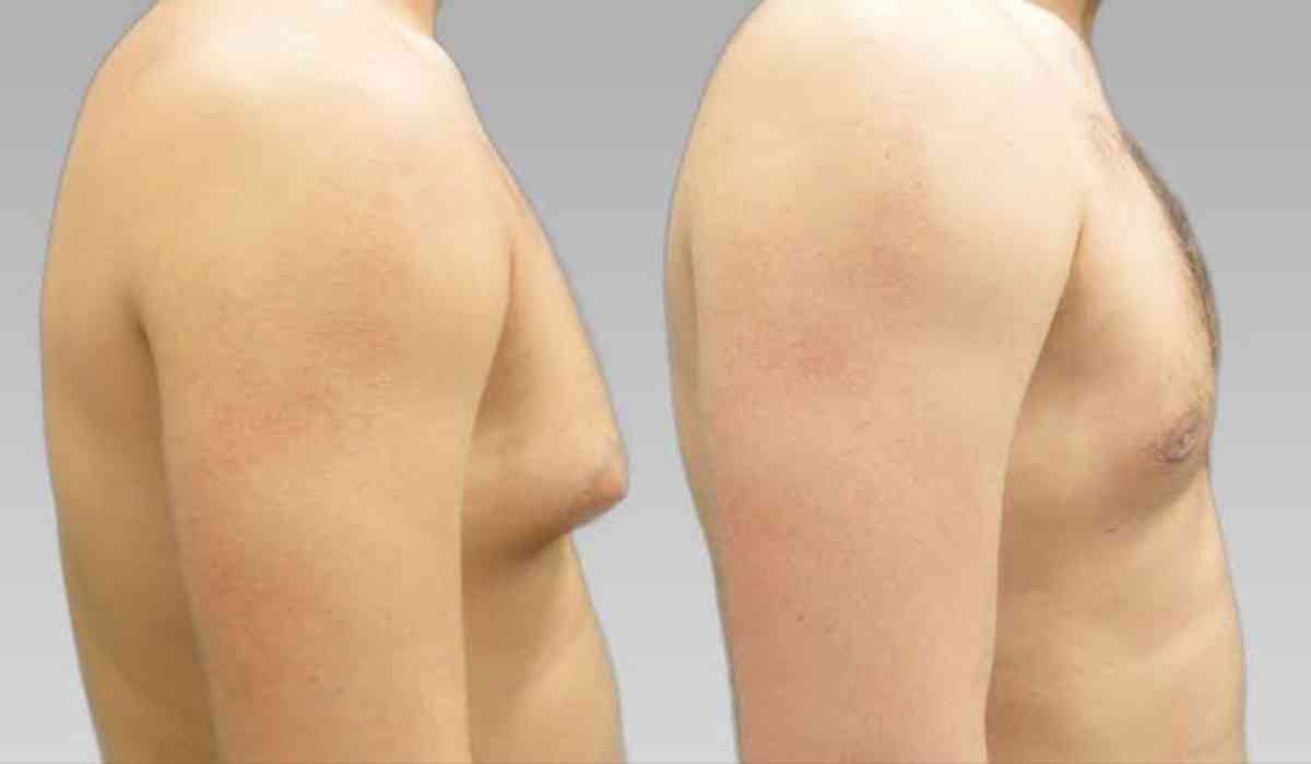 gynecomastia-surgery-cost-in-egypt
