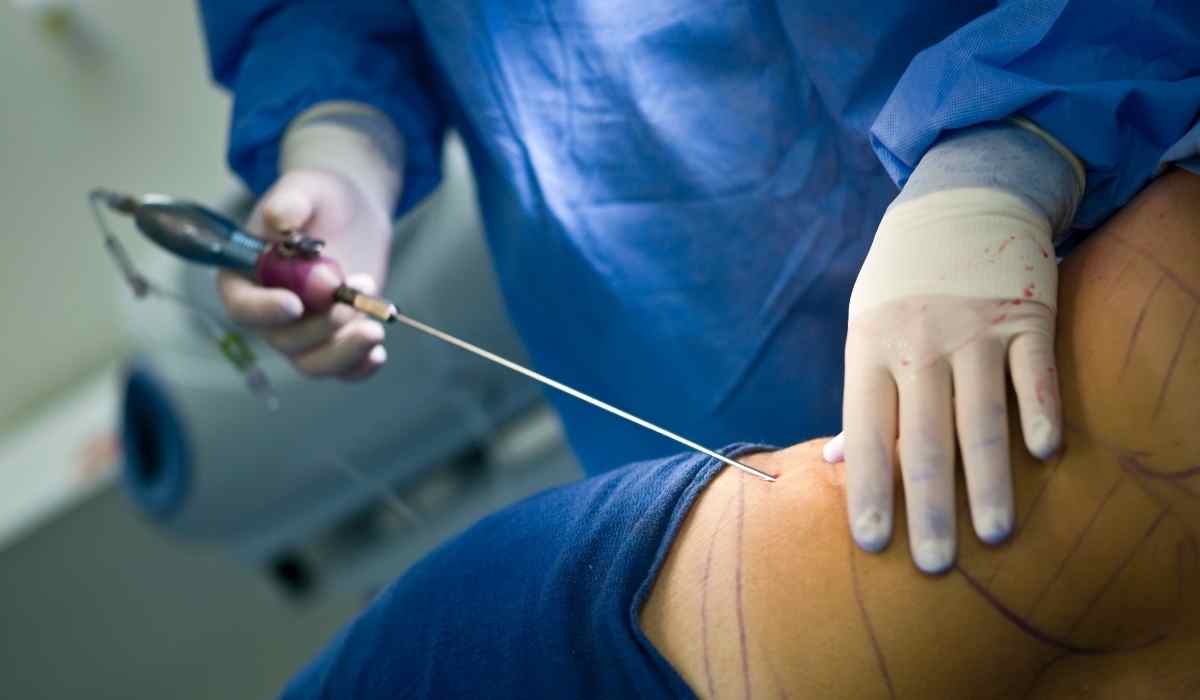 عملية-شفط-الدهون-بالفيزر-في-2025