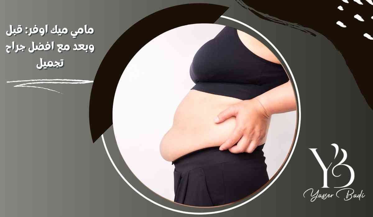 مامي ميك اوفر: قبل وبعد مع افضل جراح تجميل